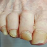 stopa przed oczyszczeniem paznokcia