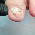 leczenie wkręcającego paznokcia