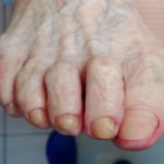 stopa po oczyszczeniu paznokcia